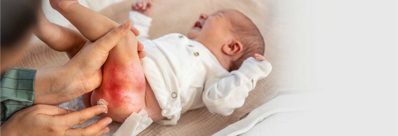 Article for Diaper Rash Clinical Study