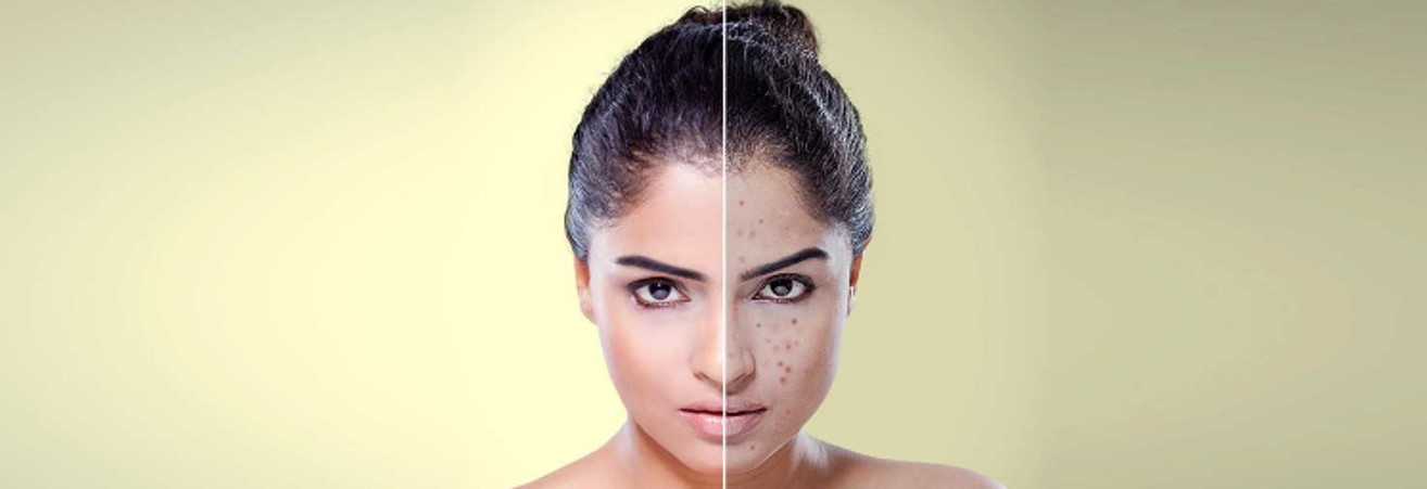 ESTEEM Study for Acne Scar